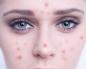 Почему кожа становится проблемной: как ее вылечить Проблемная кожа на лице